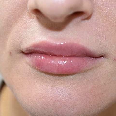 Lip fillers Before and After