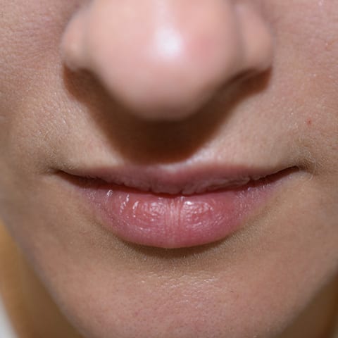 Lip fillers Before and After