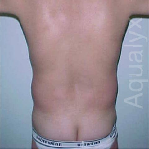 Aqualyx back treatment Before and After