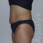 Aqualyx London Fat Dissolving Injections In Harley St London Lip Clinic aqualyx-london-fat-dissolving-injections-in-harley-st-london-lip-clinic