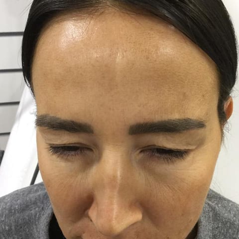 Frown Lines Botox Before and After