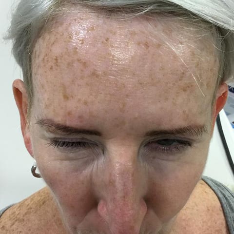Forehead Lines Botox Before and After