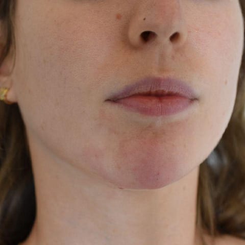 Chin Filler Before and After