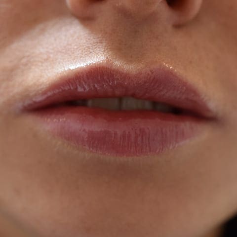 Lip fillers Before and After