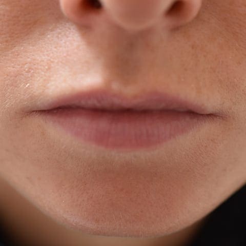 Lip fillers Before and After