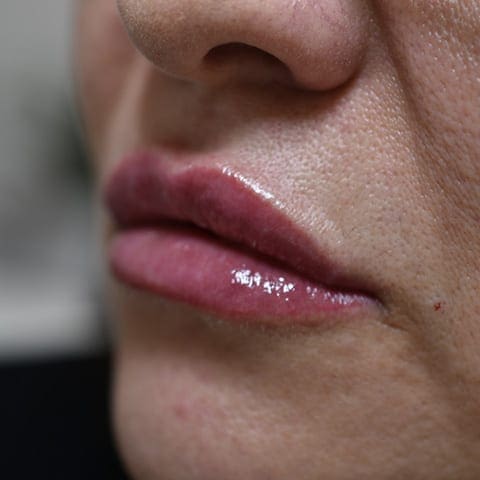 Lip fillers Before and After