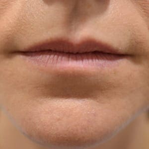 Lip fillers Before and After