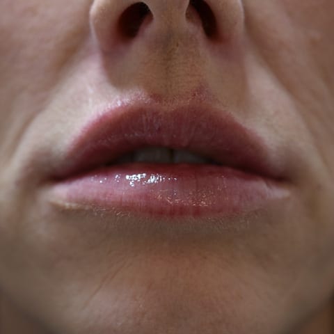 Lip fillers Before and After