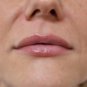 Lip fillers Before and After