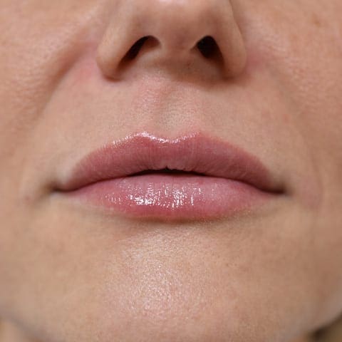 Lip fillers Before and After