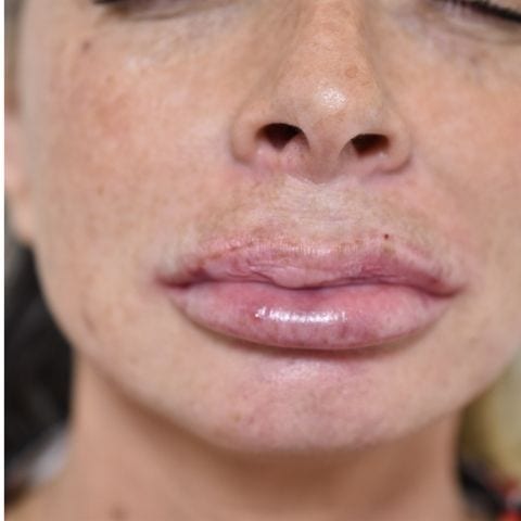Lip Filler Dissolving Treatment - Before