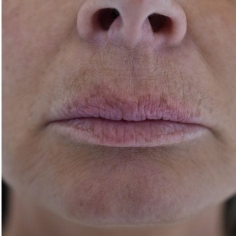 Lip Filler Dissolving Treatment - After