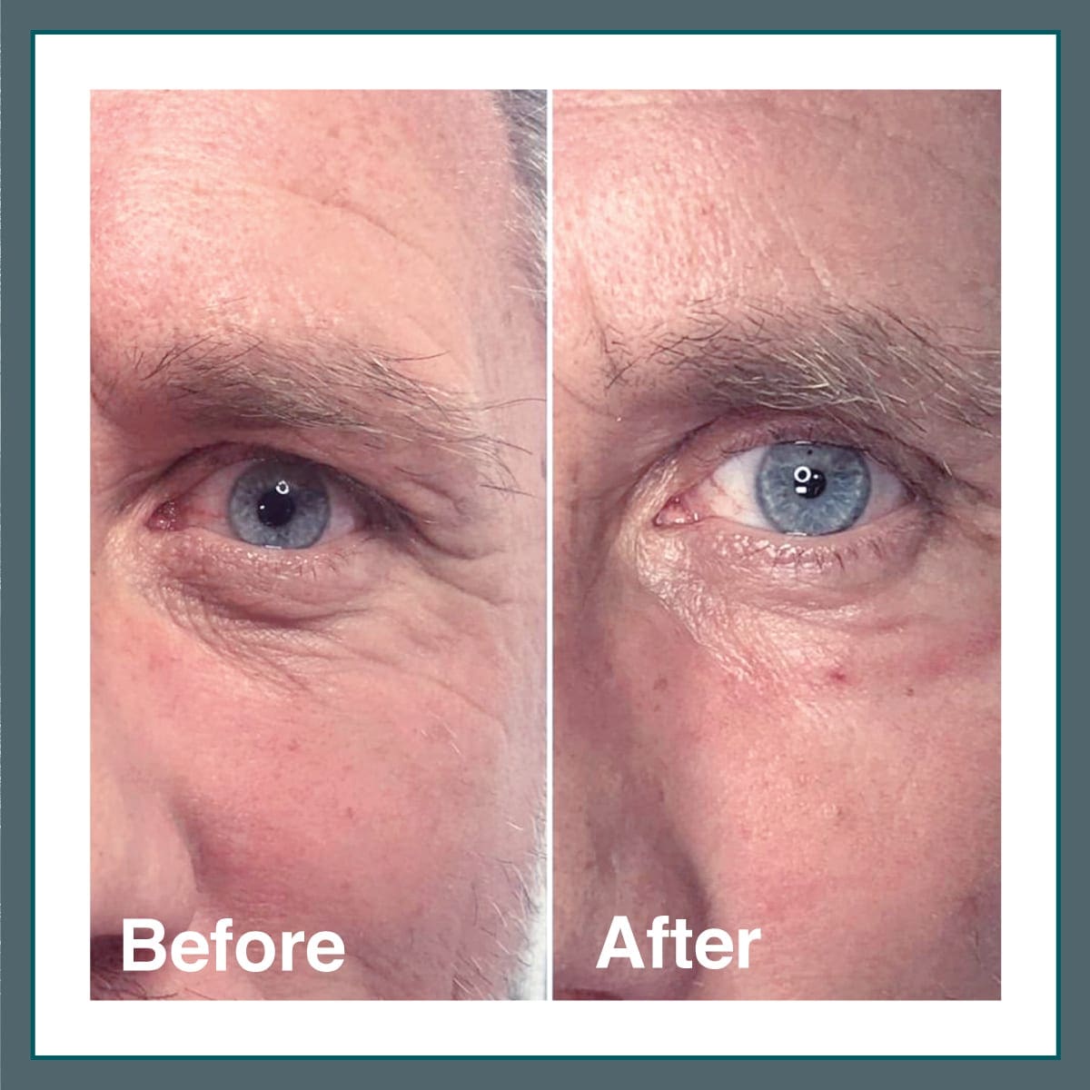 Light Eyes Ultra London Lip Clinic Best lip fillers in London