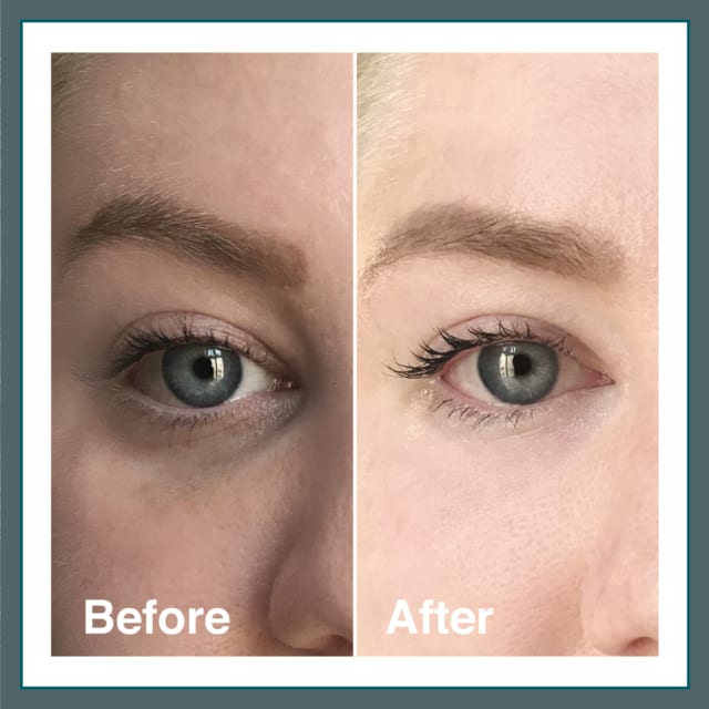 Light Eyes Treatment Before & After