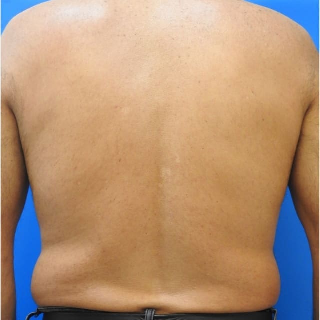 Laser-Hair-Removal-Back