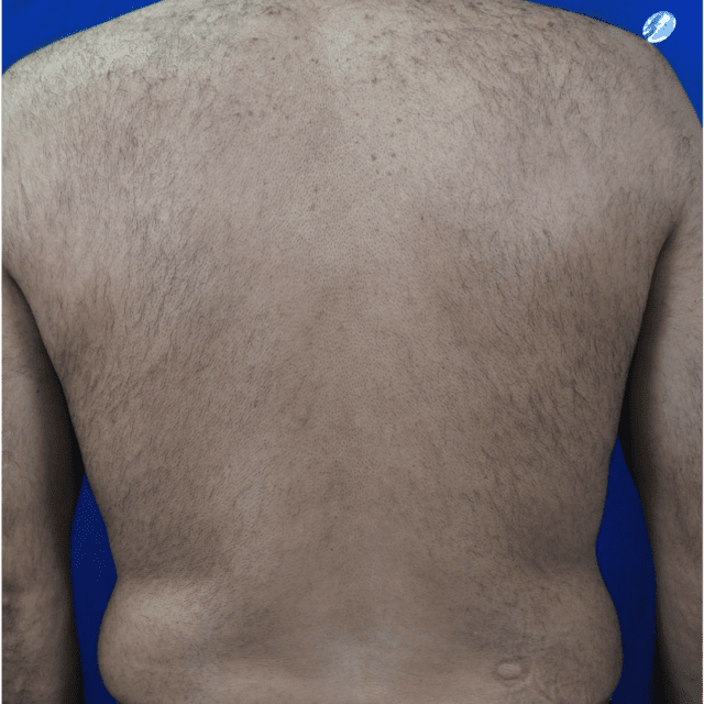 Laser-Hair-Removal-Back