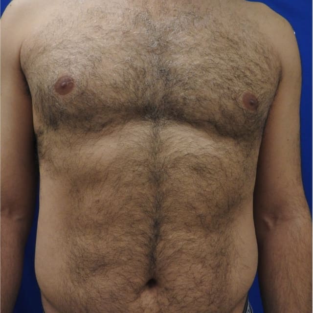 Laser-Hair-Removal-Chest